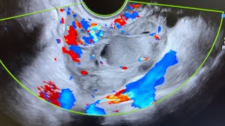 Ultrasound of acute salpingitis thick vascular fallop tube endometriotic simple amp nabothian cyst [upl. by Robbin412]