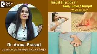 FUNGAL INFECTION in your TOES GROIN ARMPIT Causes Symptoms and Treatment  Dr Aruna Prasad [upl. by Haroved505]