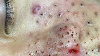 Remove Blackheads on Nose and Cheekbones [upl. by Bobbee]