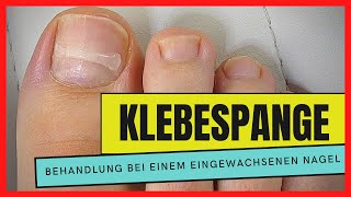 EINGEWACHSENEN NAGEL mit einer KLEBESPANGE behandeln  Podostripe Klebespange [upl. by Temirf947]