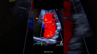 Flail MV leaflet😵🫀 echocardiogram echocardiography cardiology heartdisease [upl. by Eiffub110]