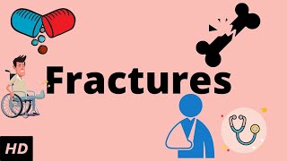 Fractures Causes Signs and Symptoms Diagnosis and Treatment [upl. by Ardle]