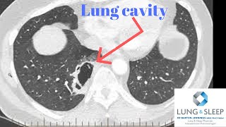 Cavitating lesion in the right lower lobe of the lung [upl. by Studnia]