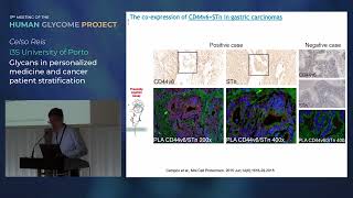 Glycosylation in cancer [upl. by Frodine309]