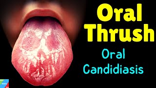 Oral Thrush  Oral Candidiasis – Symptoms Causes Diagnosis Treatment Complications [upl. by Gerri203]