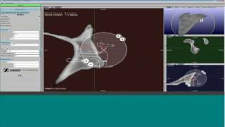 Preoperative virtual planning of the glenoid component implantation [upl. by Kared]