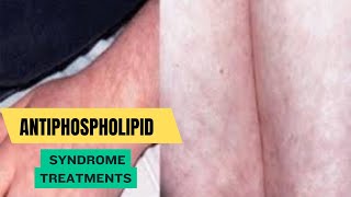 Antiphospholipid Syndrome Treatments [upl. by Ella]