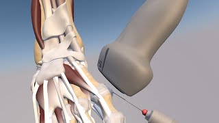 3D Model of a Ultrasound Guided First Metatarsophalangeal Joint Injection by probeultrasound [upl. by Vallonia782]