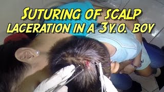 Suturing of scalp laceration in a 3yo boy [upl. by Mariele]