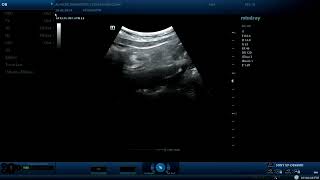 Appendicitis  ultrasound cases [upl. by Prentice]