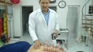 Fibromialgia  Ventosa  Ventosaterapia parte1 Clínica de Fisioterapia Dr Robson Sitta [upl. by Nyladam532]