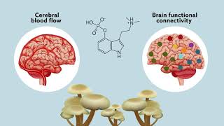 Psilocybin may ‘reset’ the brain to help manage treatmentresistant depression [upl. by Tecla940]