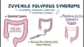 Juvenile Polyposis Syndrome [upl. by Francklin]