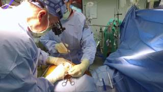 Minimally Invasive Bypass A Better Way Sanger Heart amp Vascular Institute [upl. by Ocin743]