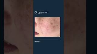 PicoSure Pigmentation Treatment [upl. by Terina]