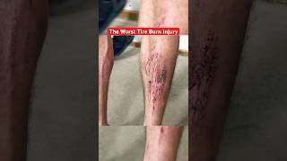 Creating the Worst Tire Burn Injury for Science funny comedy science [upl. by Ydnir]