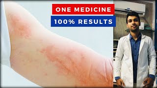 Urticaria Skin Rashes 100 Results From The First Week [upl. by Edy]