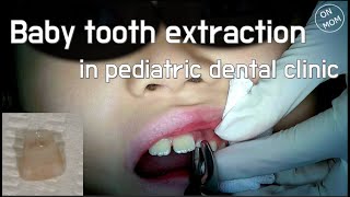 Baby tooth extraction in pediatric dental clinic [upl. by Daveta]