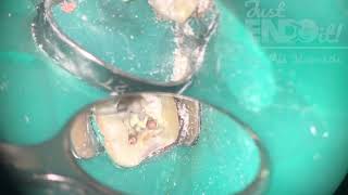 Obturation of mandibular first molar combination of MTA plug and warm vertical compaction [upl. by Merth297]