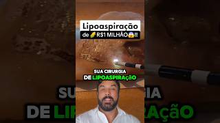 VC PAGARIA 1🌽 MILHÃO NA LIPO lipohd renuvion vaser vibrolipo lipoaspiração [upl. by Ennairam206]