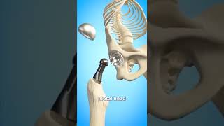 total hip replacement animation total hip replacement surgery 3d hipreplacement youtubeshorts [upl. by Adialeda925]