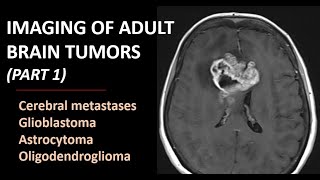 Imaging of brain tumors part 1 metastases glioblastoma and beyond [upl. by Kcitrap]