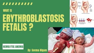 Erythroblastosis FetalisRh incompatibility and Hemolytic disease of the newborn HDN [upl. by Htezzil442]