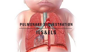 Pulmonary sequestration notes [upl. by Aiekam]