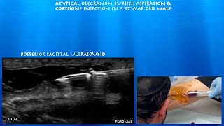 Ultrasound Guided Atypical Olecranon Bursitis Aspiration and Cortisone Injection by probeultrasound [upl. by Dermot693]