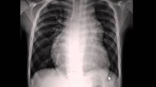 Chest xray  pulmonary arterial hypertension [upl. by Maia]