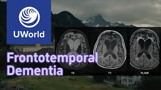 Frontotemporal Dementia vs Alzheimer Disease with Histology  UWorld USMLE MBBS [upl. by Trinia975]