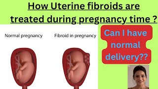 How uterine fibroids are treated during pregnancy [upl. by Yotal]