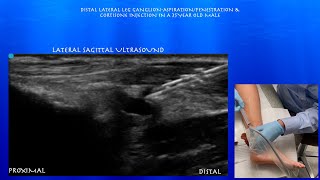 Ultrasound Guided Aspiration and Cortisone Injection of a Ganglion Abutting the Distal Fibula [upl. by Davidde]