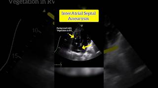 InterAtrial septal Aneurysm on Echocardiography echo heart [upl. by Mano]