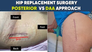 DAA vs Posterior approach for THR amp”Live QampA” Dr Pankaj Walecha 17112024TopicHipampKnee Arthritis [upl. by Obara]