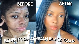 African Black Soap Uses And Benefits for Hyperpigmentation Acne and MORE [upl. by Notlil262]