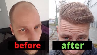 From Day 0 to Month 12  Hair Transplant Turkey Comparison [upl. by Jermyn]