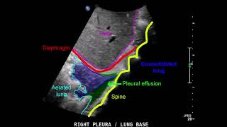 pleural effusion lung consolidation ultrasound [upl. by Rennoc373]