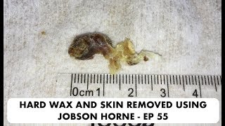 SKIN AND HARD EAR WAX REMOVAL USING JOBSON HORNE  EP 55 [upl. by Megan]