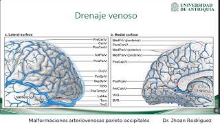 Malformaciones arteriovenosas parieto occipitales [upl. by Enined116]