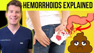 Doctor explains HEMORRHOIDS aka piles  Causes symptoms treatment amp prevention [upl. by Fernandez]