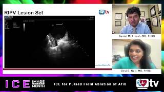 ICE Image of the Month ICE for PFA Ablation of AFib [upl. by Seni]