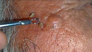 sac be spa blackheads elderly 2024  sac dep spa boy age blackheads 2024  sac be spa face today new [upl. by Zenger330]