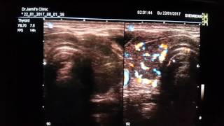 Thyrotoxicosis Ultrasound [upl. by Ailecnarf]