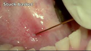 SIALENDOSCOPY FOR SIALOLITHIASIS IN SUBMANDIBULAR GLAND  SELDINGER TECHNIQUE  DISTAL PAPILLOTOMY [upl. by Adnilre]