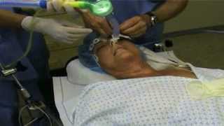 Fiberoptic Intubation [upl. by Enitsirhk]