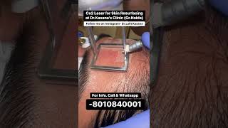 co2 laser treatment for acne scars  DrLalit Kasanas [upl. by Kurtis]