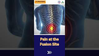 What Are The Symptoms Of Spinal Fusion  spinalfusion spinesurgery surgery india shortvideo [upl. by Oinotnas807]