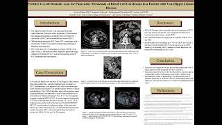 Positive GA68Dotatate PETCT scan for Pancreatic Metastasis of Renal Cell Carcinoma [upl. by Ima]