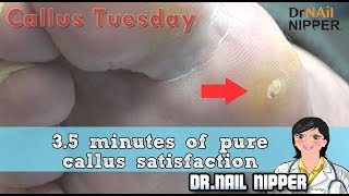 How 35 minutes of satisfaction can be with Pure Foot Calluses 24  Callus Tuesday [upl. by Nixon]